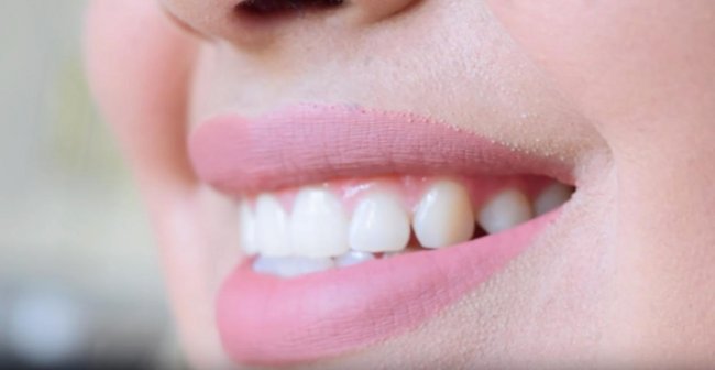 Безопасное отбеливание зубов в домашних условиях